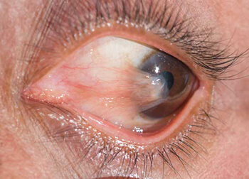 Pterygium