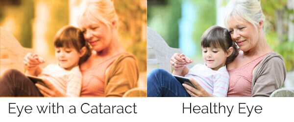 Chart showing vision with a healthy eye compared to one with a cataract